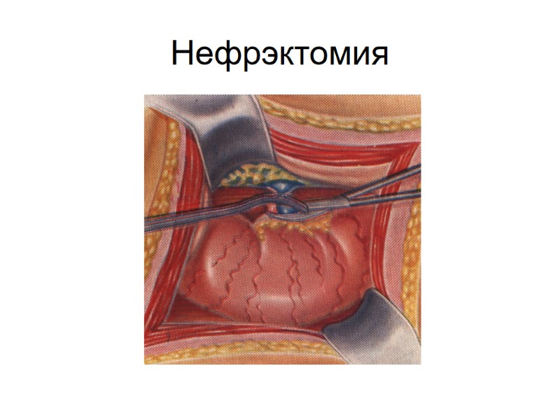 Нефрэктомия